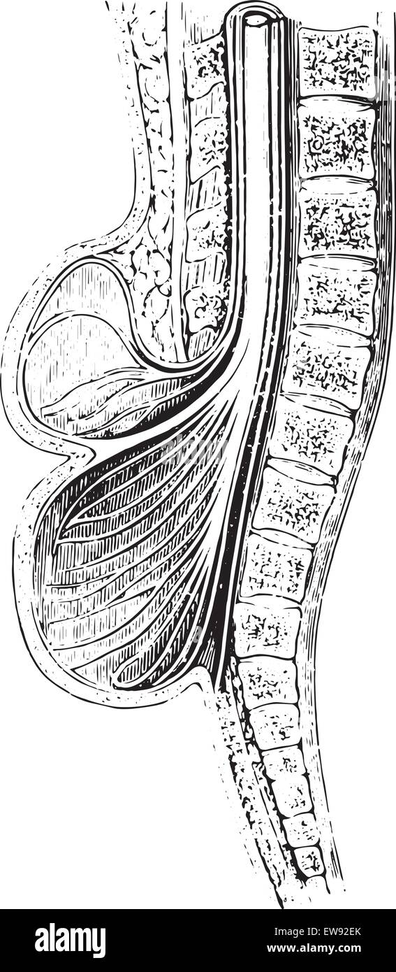 Tasse Anteroposterior Wirbelsäule auf eine Spina Bifida, Vintage gravierten Abbildung geübt. Üblichen Medizin Wörterbuch von Dr. Labarthe Stock Vektor