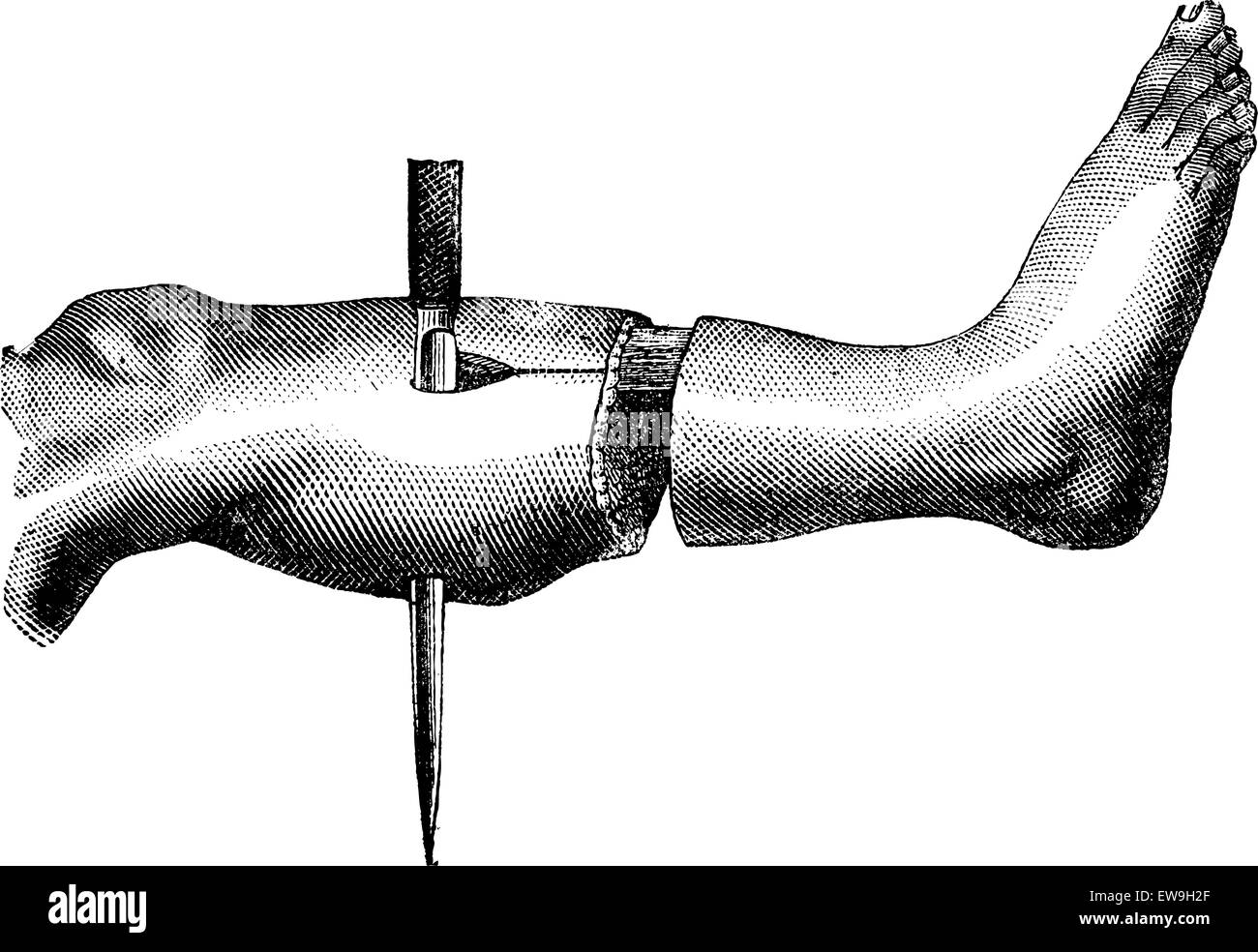 Amputation des Beins von der Methode hat zwei Klappen (Bildung der zweiten Klappe), Vintage Illustration Gravur. Magasin Pitto Stock Vektor