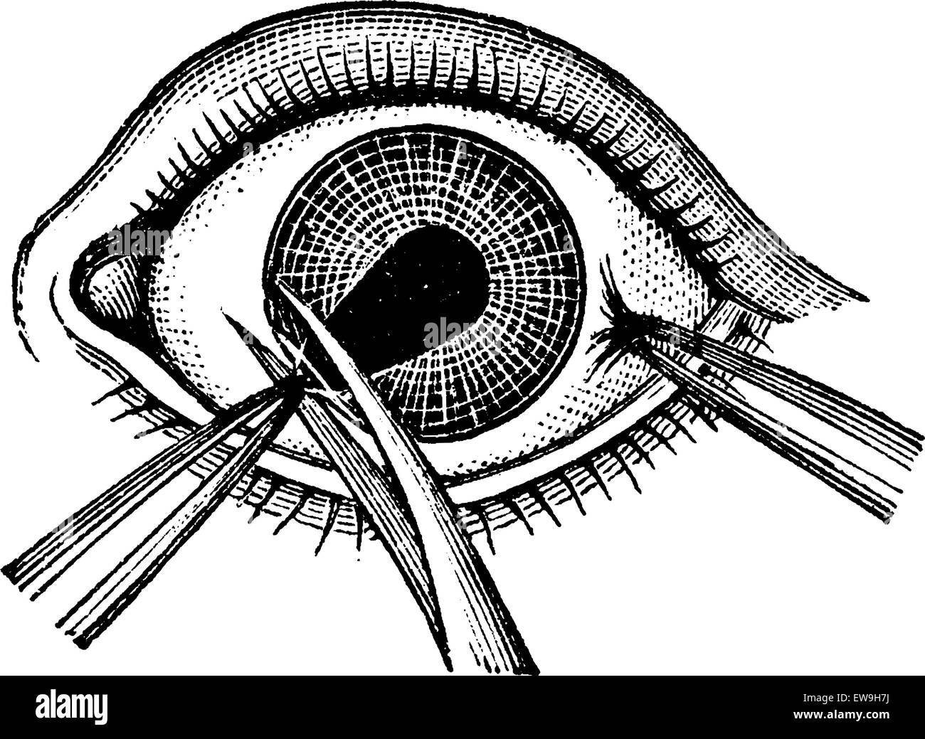Iridektomie, graviert mit Zange entfernen eine Klappe der Iris, Vintage Illustration. Üblichen Medizin Wörterbuch von Dr. Labarthe Stock Vektor