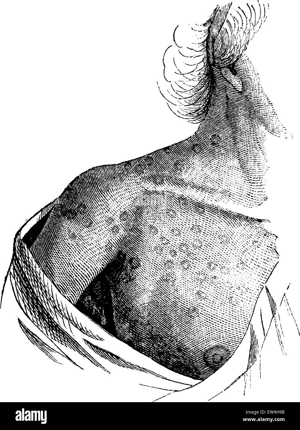 Coenurosis, entstellende Knötchen auf der Haut einer Frau, Vintage gravierten Abbildung zeigt. Üblichen Medizin Wörterbuch von Dr. Labart Stock Vektor