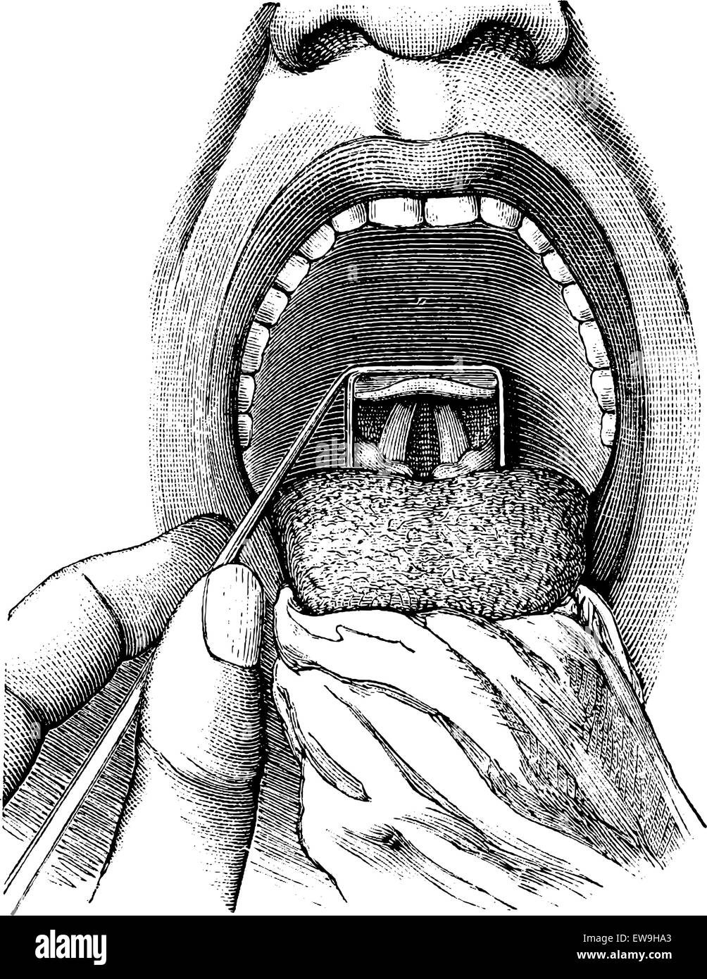 Laryngoskopie, Einblick in ein Patient Hals, Vintage gravierten Abbildung zeigt. Üblichen Medizin Wörterbuch von Dr. Labarthe - 18 Stock Vektor
