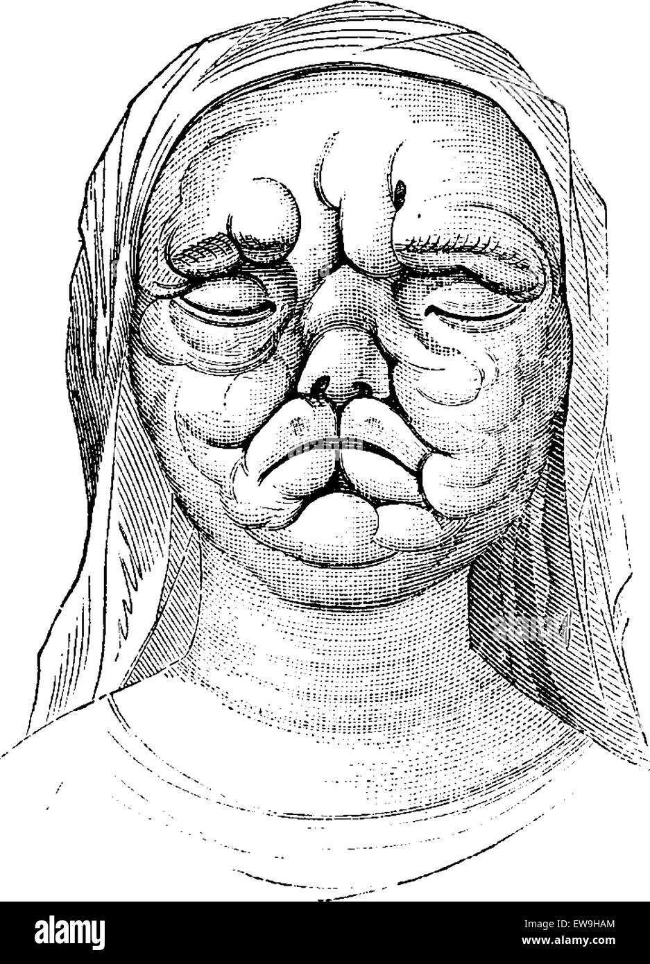 Lepra oder Hansen-Krankheit, zeigt eine Frau mit Gesichtshaut unregelmäßig verdickt, Vintage gravierten Abbildung. Üblichen Medici Stock Vektor