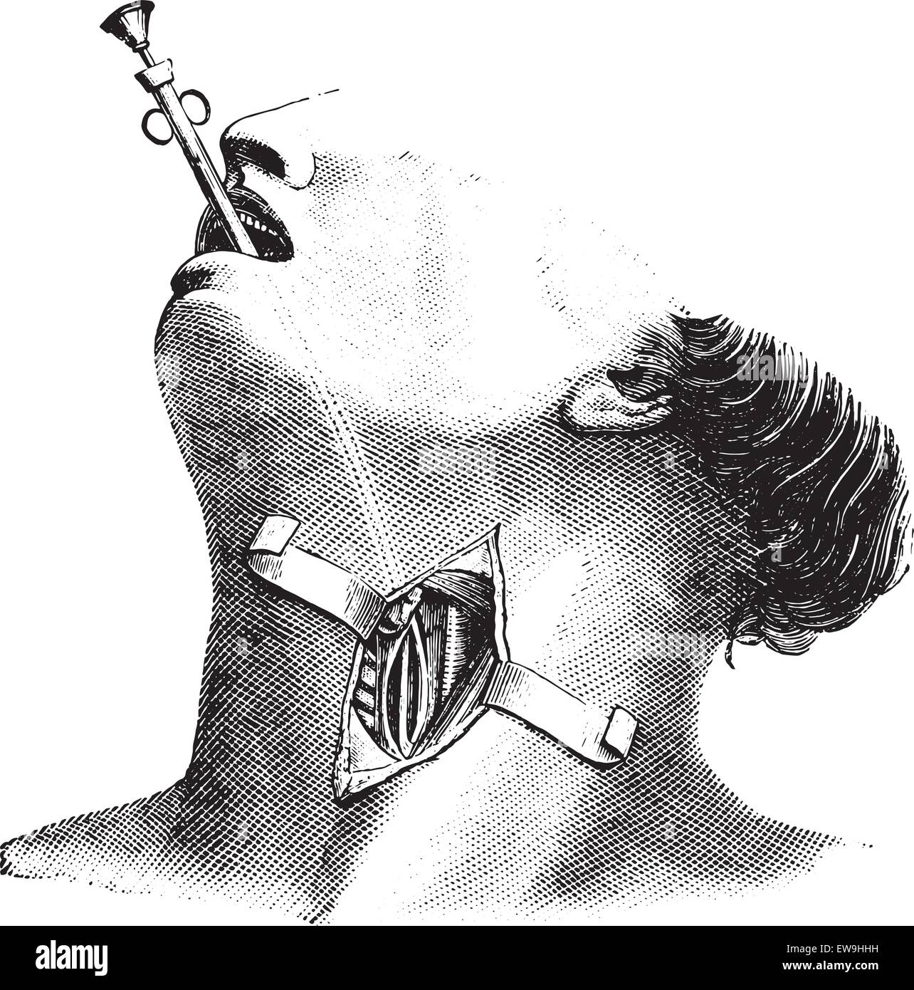 Externen Ösophagektomie graviert Vintage Illustration. Üblichen Medizin Wörterbuch - Paul Labarthe - 1885. Stock Vektor