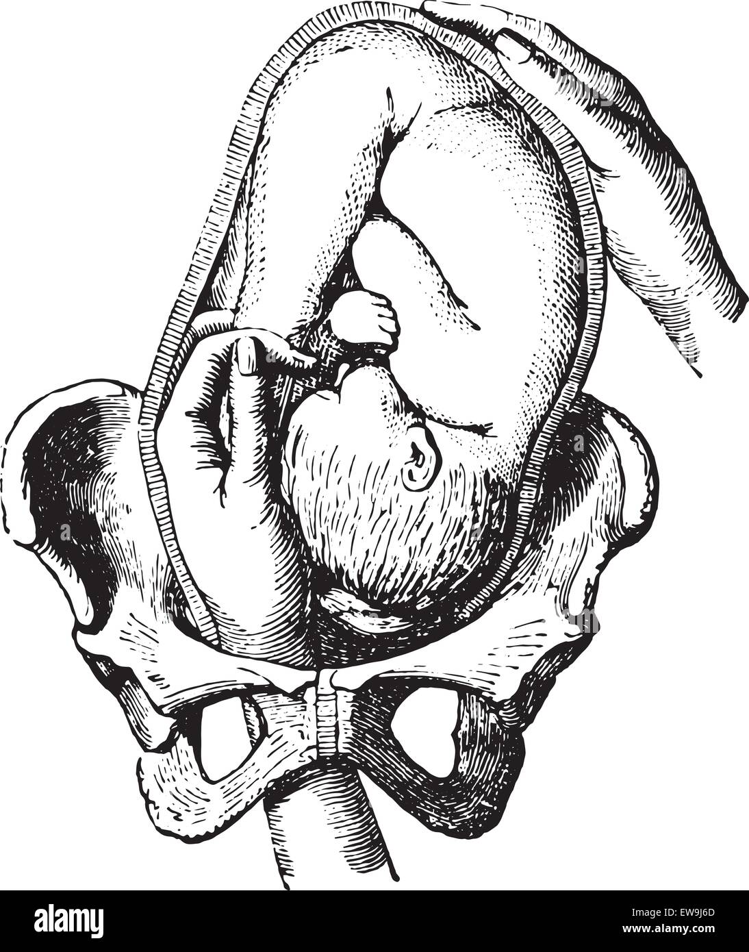 Externe cephalic Version, wie man die Füße um das Kind auf seinen früheren Plan, Vintage gravierten Abbildung zu streicheln. U Stock Vektor