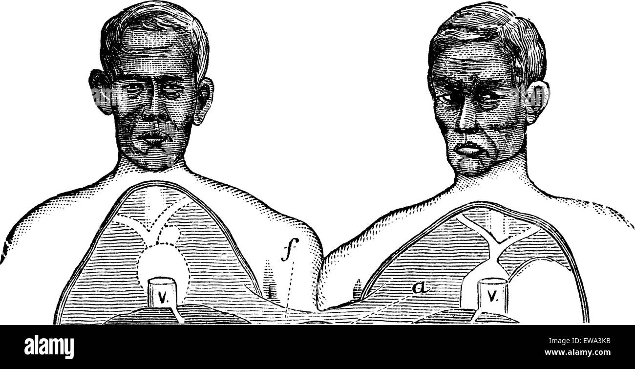 Siamesische Zwillinge. V. Vena cava. w. Obere Grenze für die gemeinsame Achse, Vintage eingravierten Abbildung. Trousset Enzyklopädie (1886 - 1891). Stock Vektor