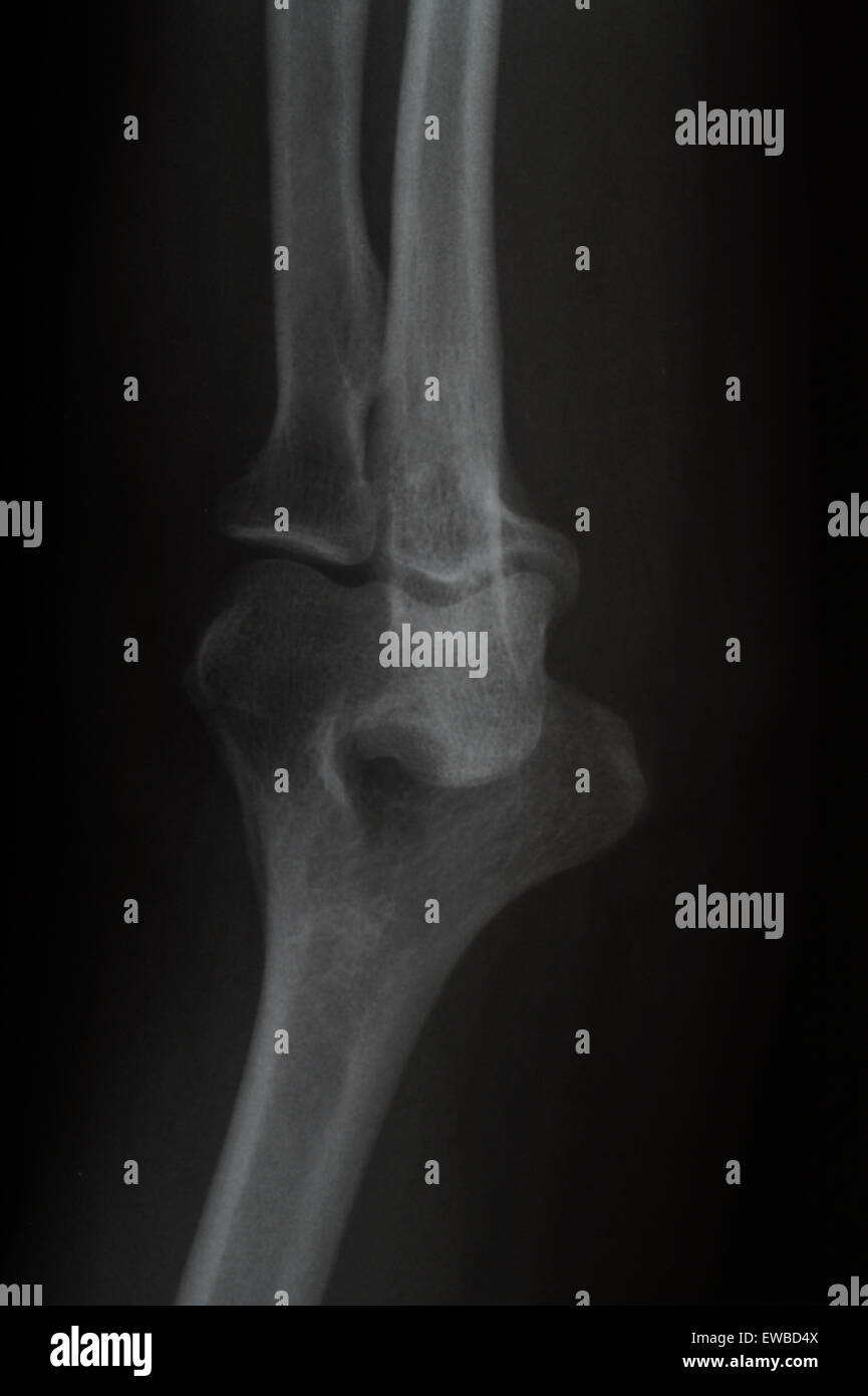 X-Ray Bild der Ellenbogen durch den Arzt in der Prüfung verwendet werden Stockfoto