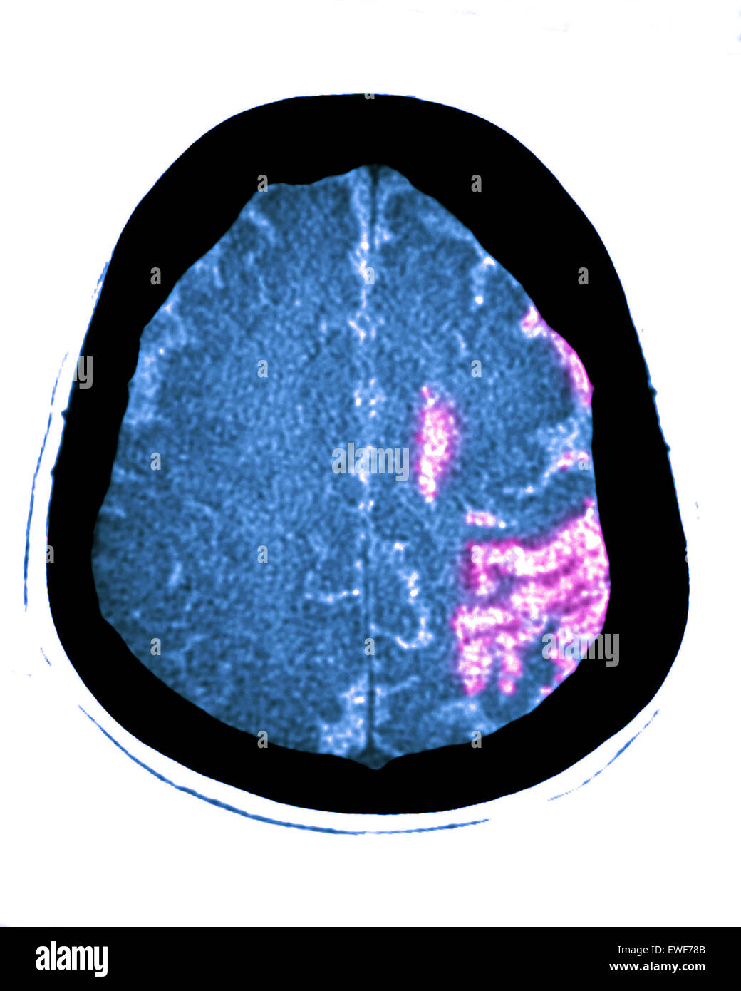ZEREBRALE ATROPHIE, CT-SCAN Stockfoto