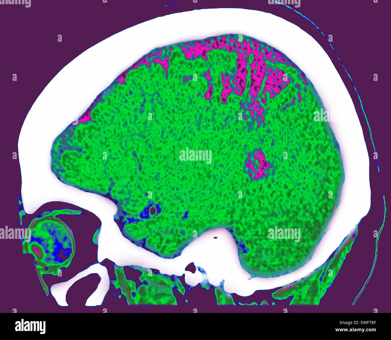 ZEREBRALE ATROPHIE, CT-SCAN Stockfoto