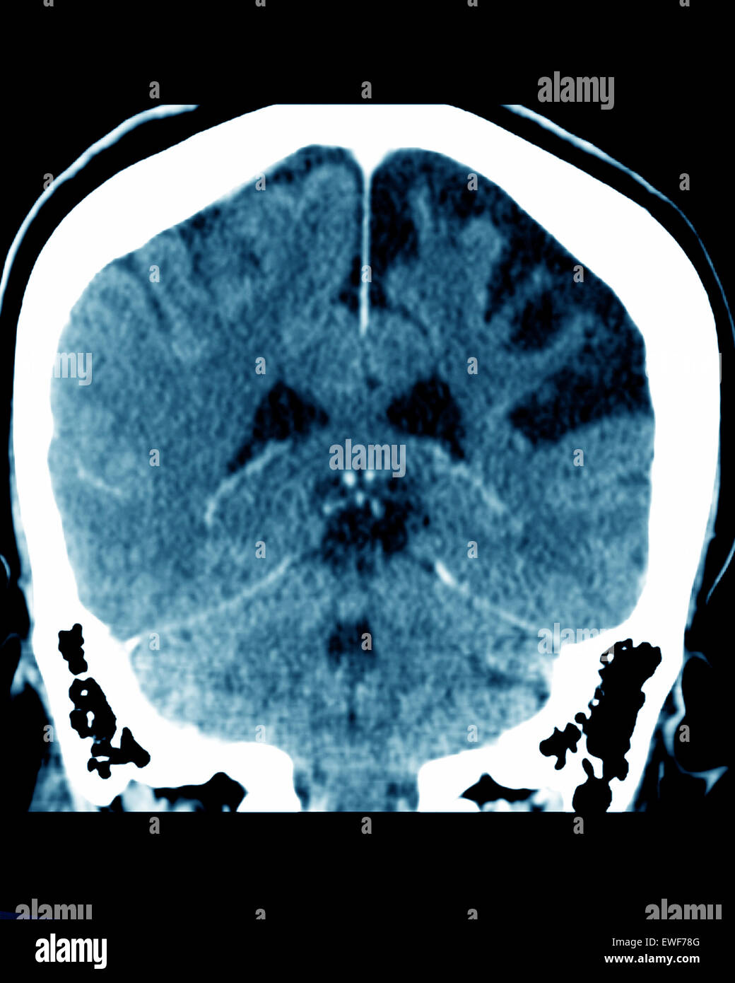 ZEREBRALE ATROPHIE, CT-SCAN Stockfoto