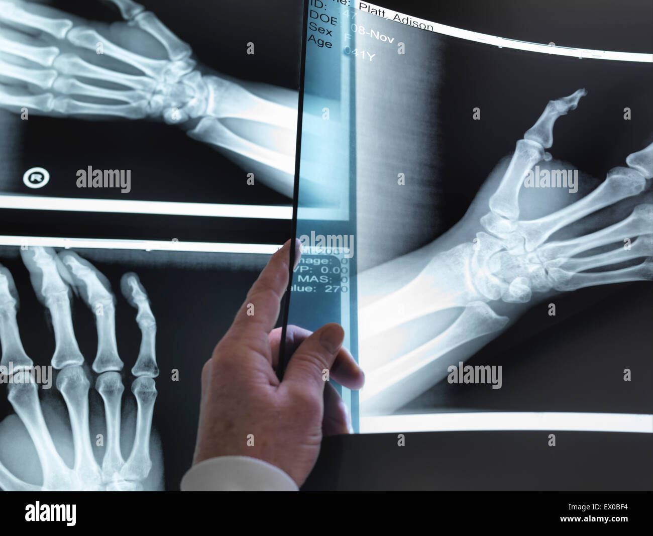 Ärzte Hand hochhalten Hand Xray im Krankenhaus Stockfoto