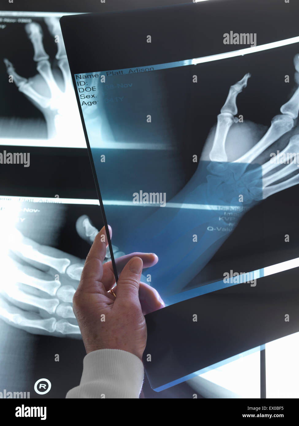 Arzt Röntgenaufnahmen der Hand im Krankenhaus anzeigen Stockfoto