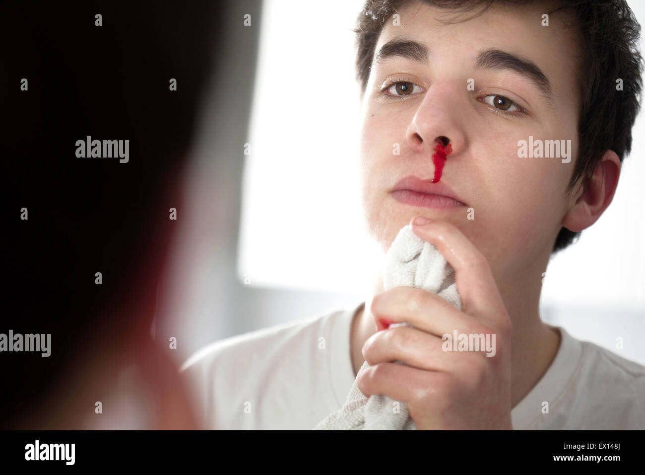 -MODELL VERÖFFENTLICHT. Junger Mann mit Nasenbluten. Stockfoto