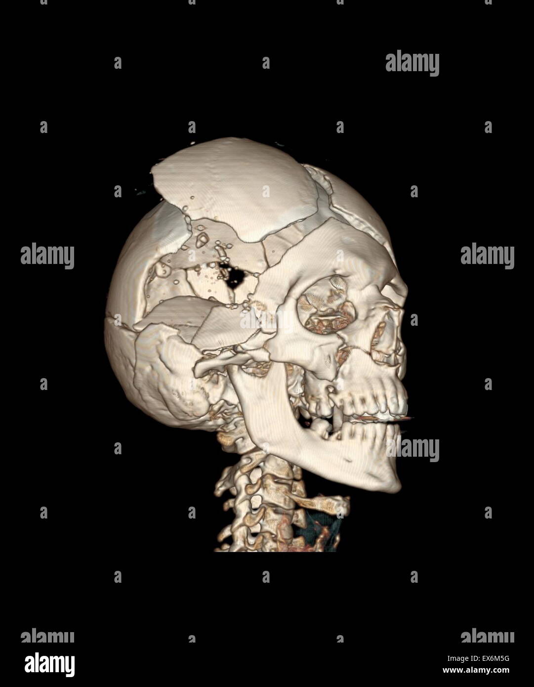 Ansicht von rechts ventral einer dreidimensionalen CT-Rekonstruktion des knöchernen Schädels mit Schussverletzungen zeigt das Loch der Ausfahrt Wunde durch die rechtsseitige zeitlichen Eingang Wunde, 2003 Stockfoto