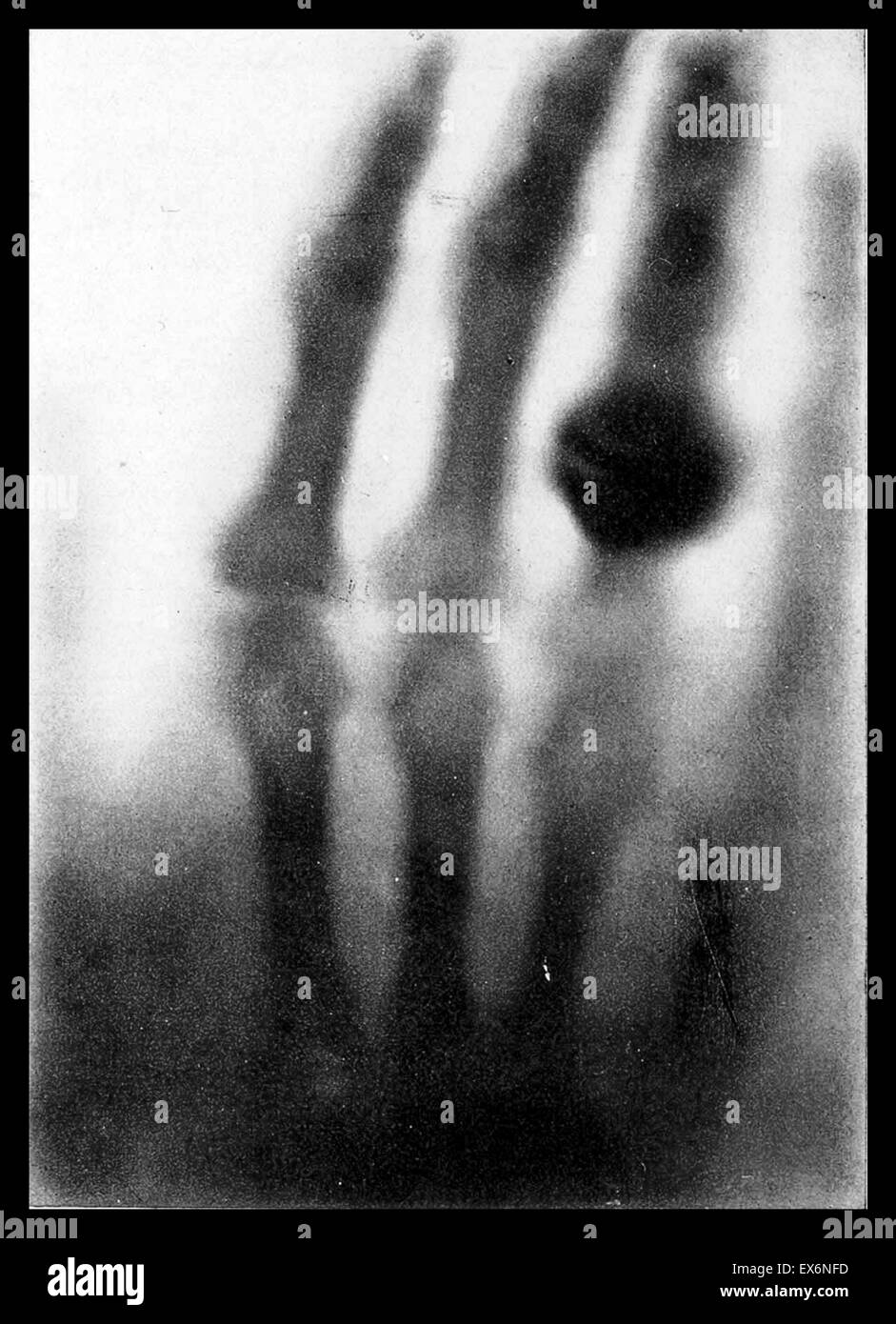 Die Hand der Frau Wilhelm Roentgen: das erste Röntgenbild, 1895 Stockfoto