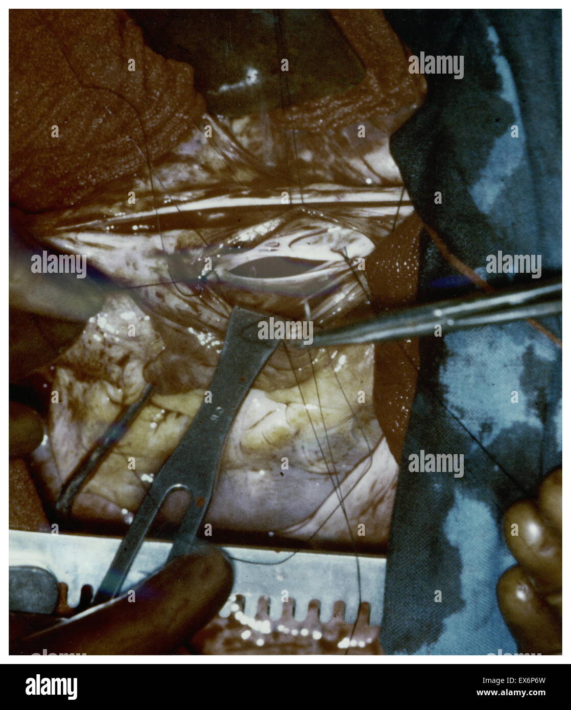 1953 erste Bild vom Inneren des Herzens in eine offene Herzoperation durch amerikanische Chirurg Henry Swan II (1913 – 1996). Swan Pionier im Einsatz von Hypothermie (Kühlung Patienten auf eine sehr niedrige Körpertemperatur), um den ersten Operationen am offenen Herzen zu ermöglichen. Dabei Stockfoto