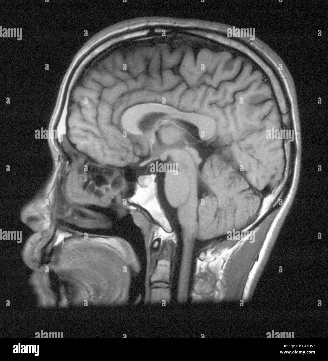 MRI des Kopfes zeigt normale Hirnstrukturen. Stockfoto