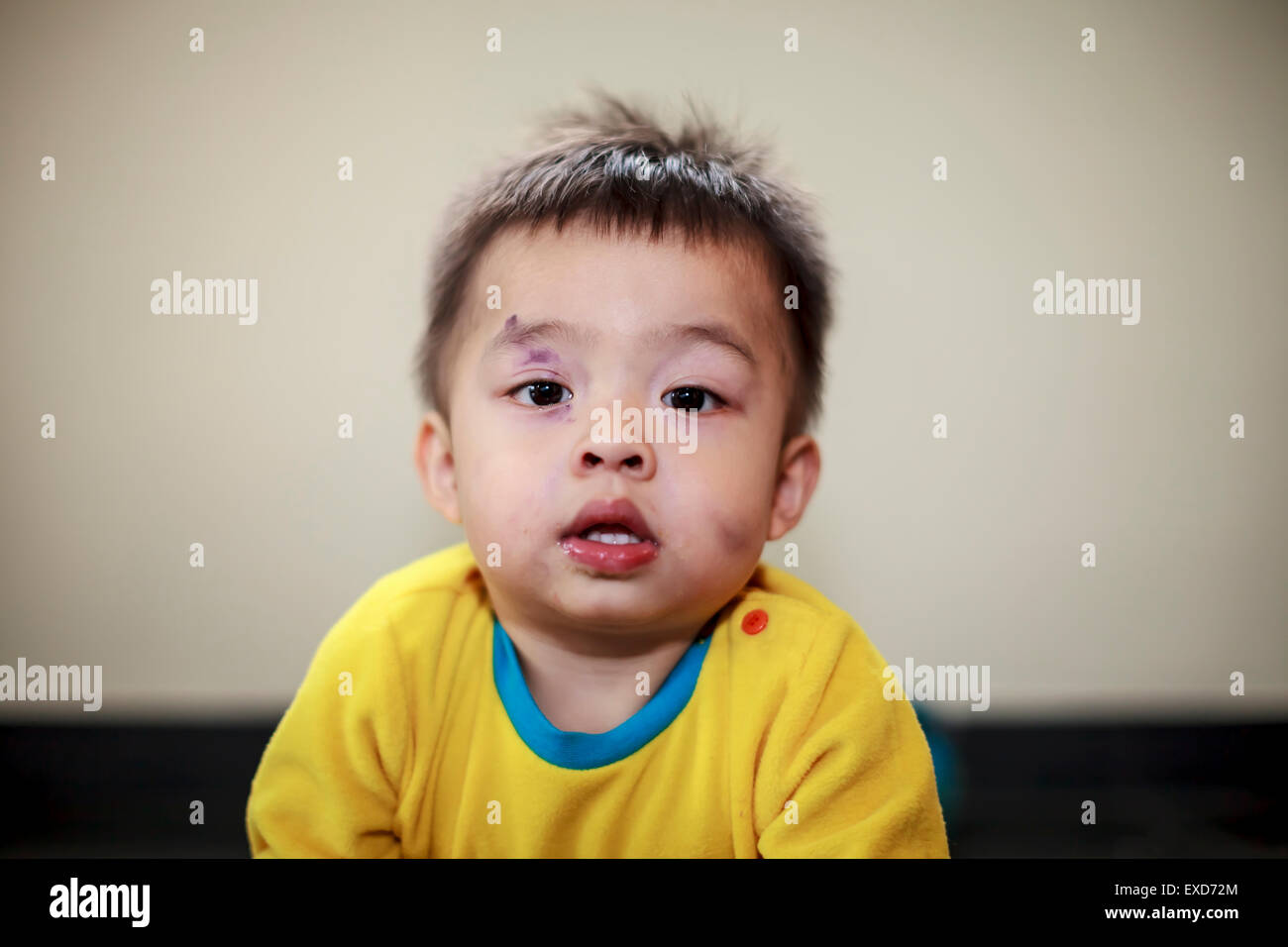 Ein Kind mit einem blauen Auge und blaue Flecken im Gesicht Stockfoto