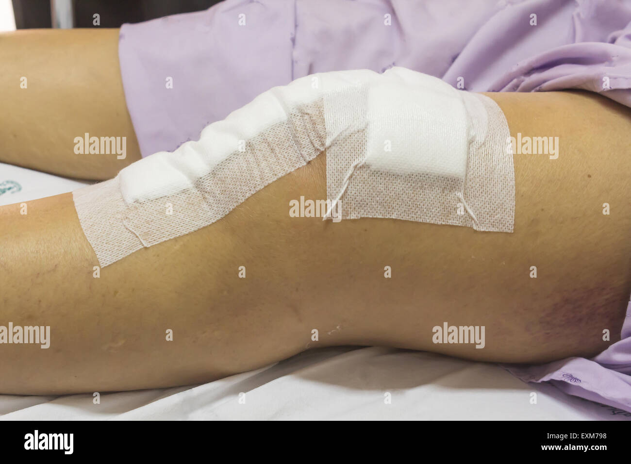 Kniegelenkersatz-Operation nach der Operation Patienten senior Frau (60er Jahre) auf dem Bett im Krankenhaus Stockfoto