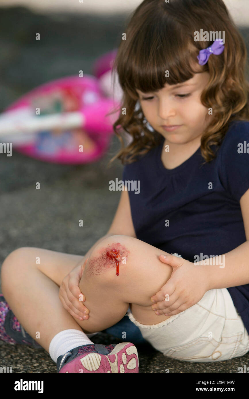 Junges Mädchen - 6-7 mit gehäutet Knie.  Dies ist ein Modell, Wunde ist fake - Make-up verwendet wurde.  -Modell veröffentlicht. Stockfoto