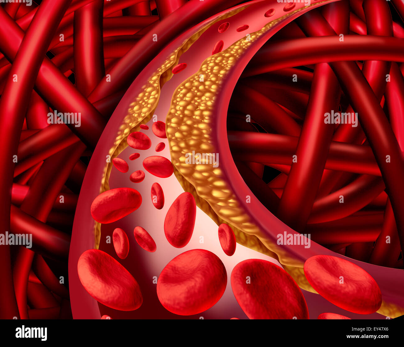 Arterie Problem mit verstopften Arterien und Atherosklerose medizinische Krankheitskonzept mit drei dimensionale menschliche Herz-Kreislauf-System mit Blut Zellen, die als Symbol für Gefäßerkrankungen durch Plaque-Bildung von Cholesterin blockiert. Stockfoto