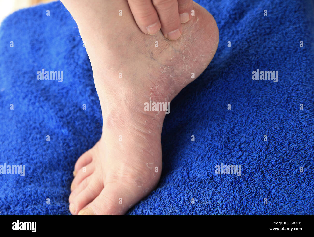 Fuãÿpilz der athleten -Fotos und -Bildmaterial in hoher Auflösung – Alamy