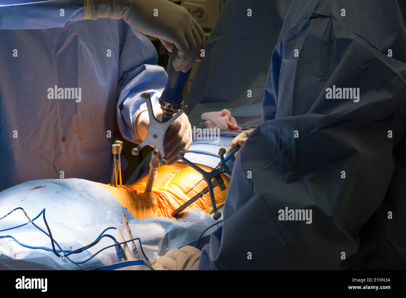 Englewood, Colorado - Dr. Erik Parker führt minimalinvasive Lendenwirbel instrumentierten Fusion im schwedischen Medical Center. Stockfoto