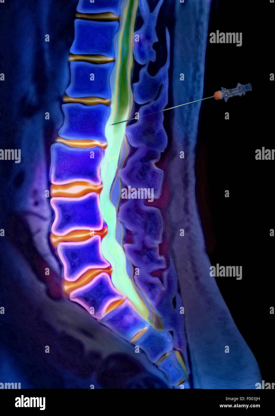 Röntgenbild der eine Disc Prolaps Stockfoto