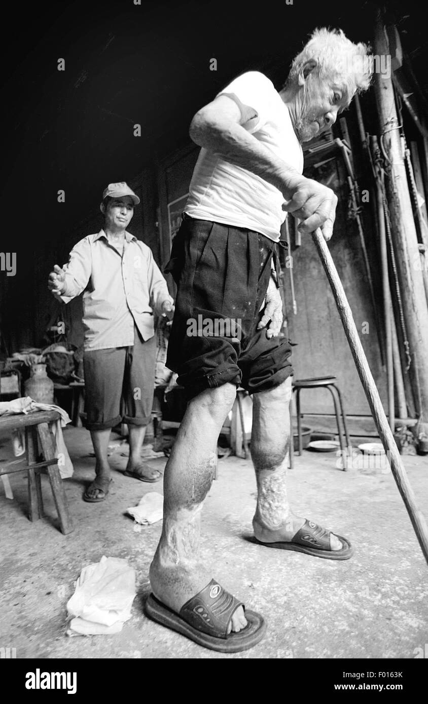 (150806)--Peking, 6. August 2015 (Xinhua)--A Opfer der japanischen Bakterienkrieg begangen in China während des zweiten Weltkriegs Spaziergänge mit Krücken in Yiwu, Ost-China Zhejiang Provinz, 5. Juli 2005. Invasion der japanischen Truppen eingerichtet 60 Bakterienkrieg Einheiten Beteiligten mehr als 10.000 Soldaten von 1932 bis 1945 in China und als Opfer mindestens 270.000 chinesische Zivilisten. Japanische Truppen, einschließlich der berüchtigten Einheit 731, entwickelt und produziert Keim Waffen basierend auf Bakterien Experimente an menschlichen Körpern und Keim Waffen gegen chinesische Zivilisten in Schlachten verwendet und freigegeben, Pest, Anthraknose und glande Stockfoto
