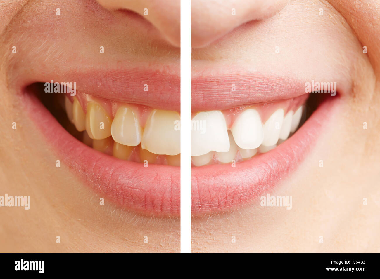 Vor und nach dem Vergleich der Zahnweißung einer jungen Frau Stockfoto