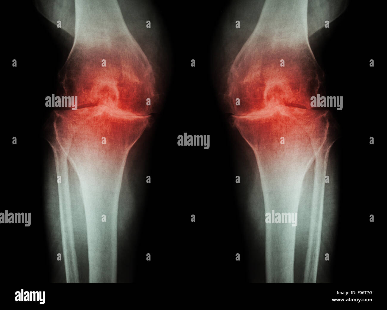 Knie Osteoarthritis (OA Knie) (beide-Arthritis des Kniegelenks Knie Roentgenfilm: schmale Knie Gelenkspalt) (Medizin- und Sc Stockfoto
