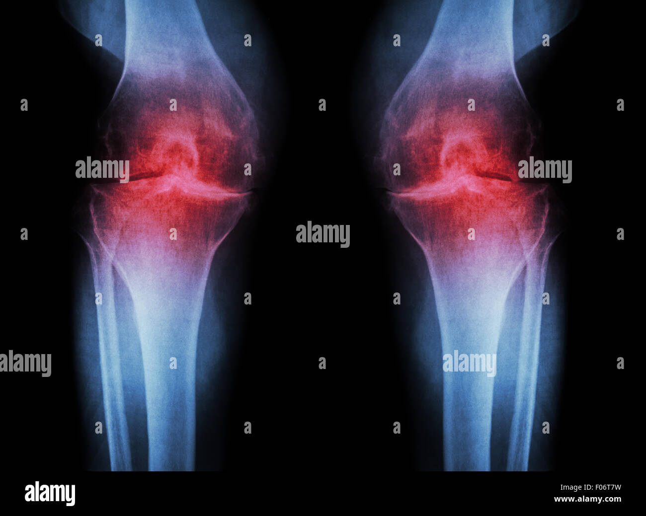 Knie Osteoarthritis (OA Knie) (beide-Arthritis des Kniegelenks Knie Roentgenfilm: schmale Knie Gelenkspalt) (Medizin- und Sc Stockfoto