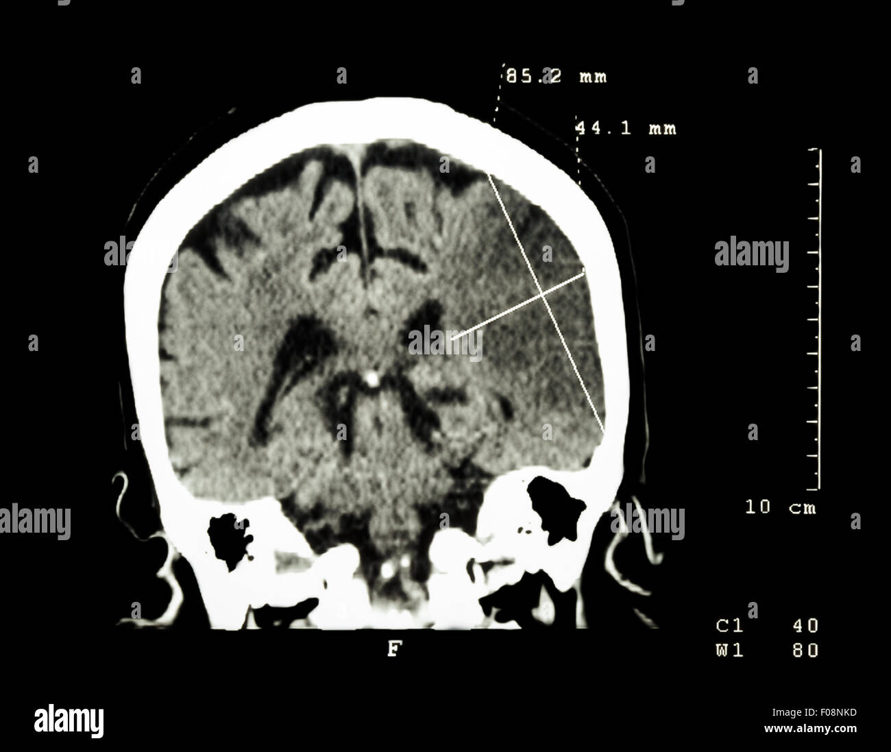 Hirninfarkt am linken Hemisphäre (ischämischer Schlaganfall) (CT-Scan ...