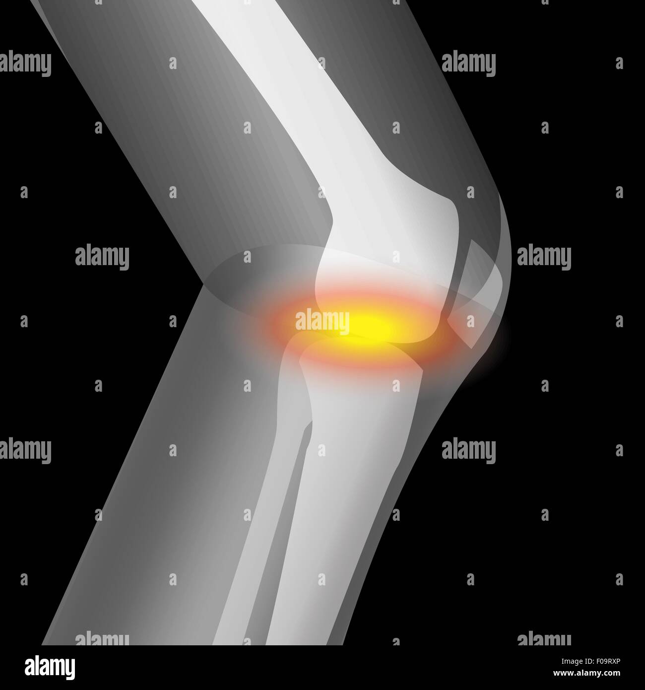 Arthritis im Knie, Schmerzen Knie, Knie Leiden, Vektor Stock Vektor