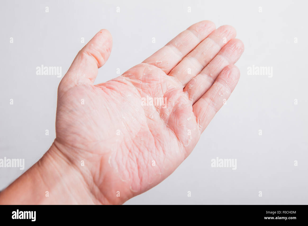Krank allergische Ausschlag Dermatitis Ekzeme Hautstruktur an Hand des