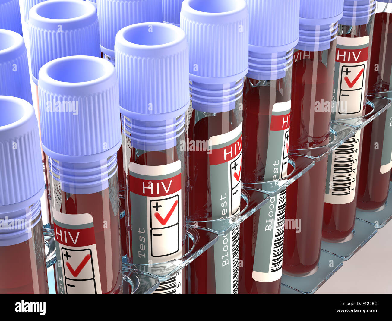 Bild-Konzept mit dem Ergebnis des HIV-Tests. Stockfoto