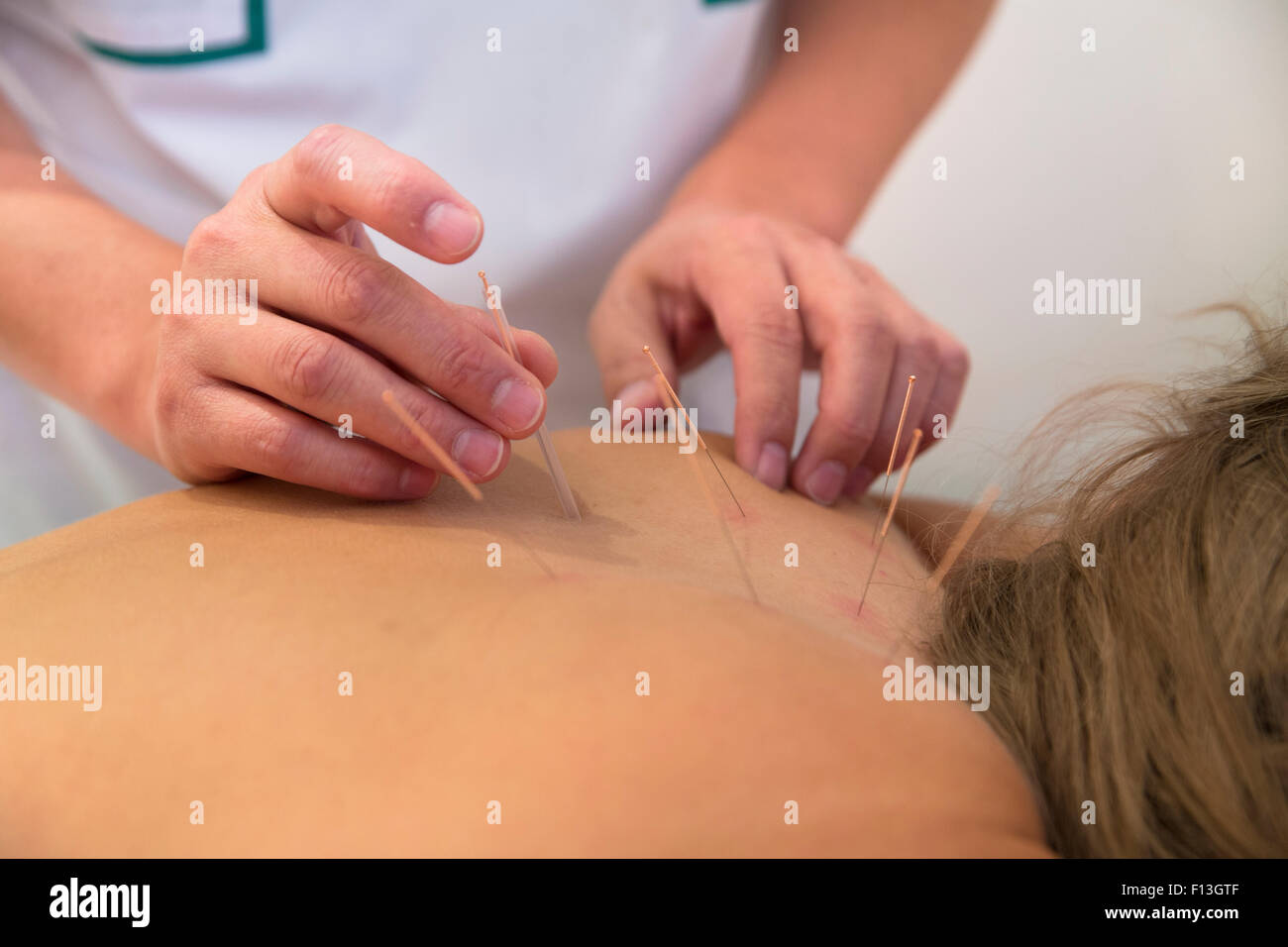 Akupunkturnadeln auf der Rückseite einer jungen Frau Stockfoto