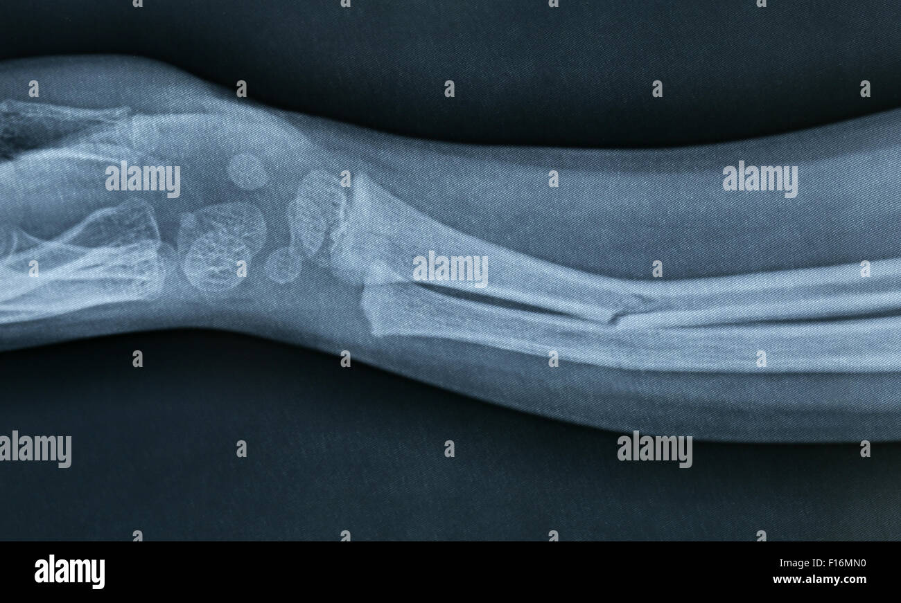 Nahaufnahme einer Brokan Hand Xray Stockfoto