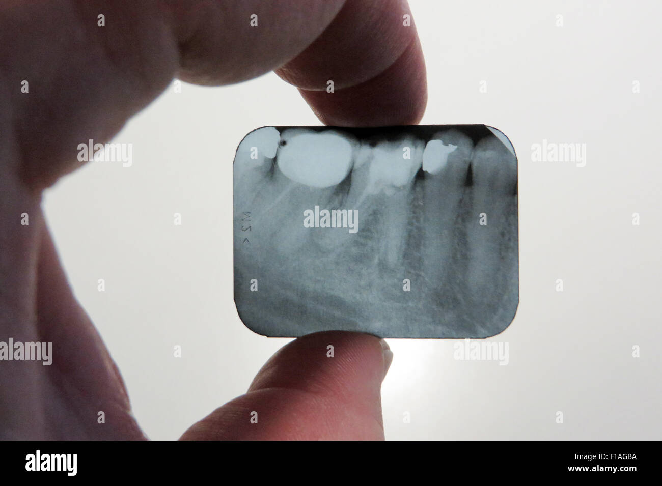 Berlin, Deutschland, Röntgen-Thorax einer Wurzelkanalbehandlung, gekrönt und Zähne versiegelt Stockfoto