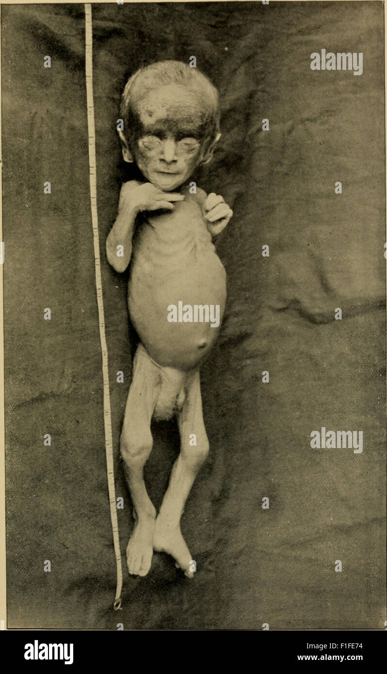 „An American Text-Book of the Diseases of Children“ (1895) ist ein umfassender medizinischer Leitfaden zu pädiatrischen Erkrankungen, der detaillierte Beschreibungen, Symptome und Behandlungen für verschiedene kindliche Beschwerden bietet. Dieses alte medizinische Buch ist eine wichtige Ressource in der Geschichte der pädiatrischen Versorgung. Stockfoto