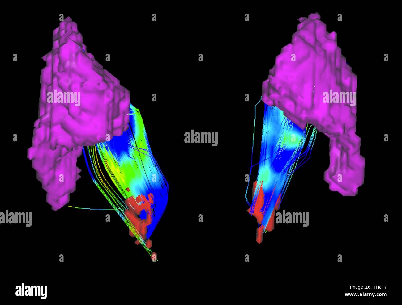 Verbindungen zwischen der Substancia Nigra und Putamen in einer Parkinson-Erkrankung Stockfoto
