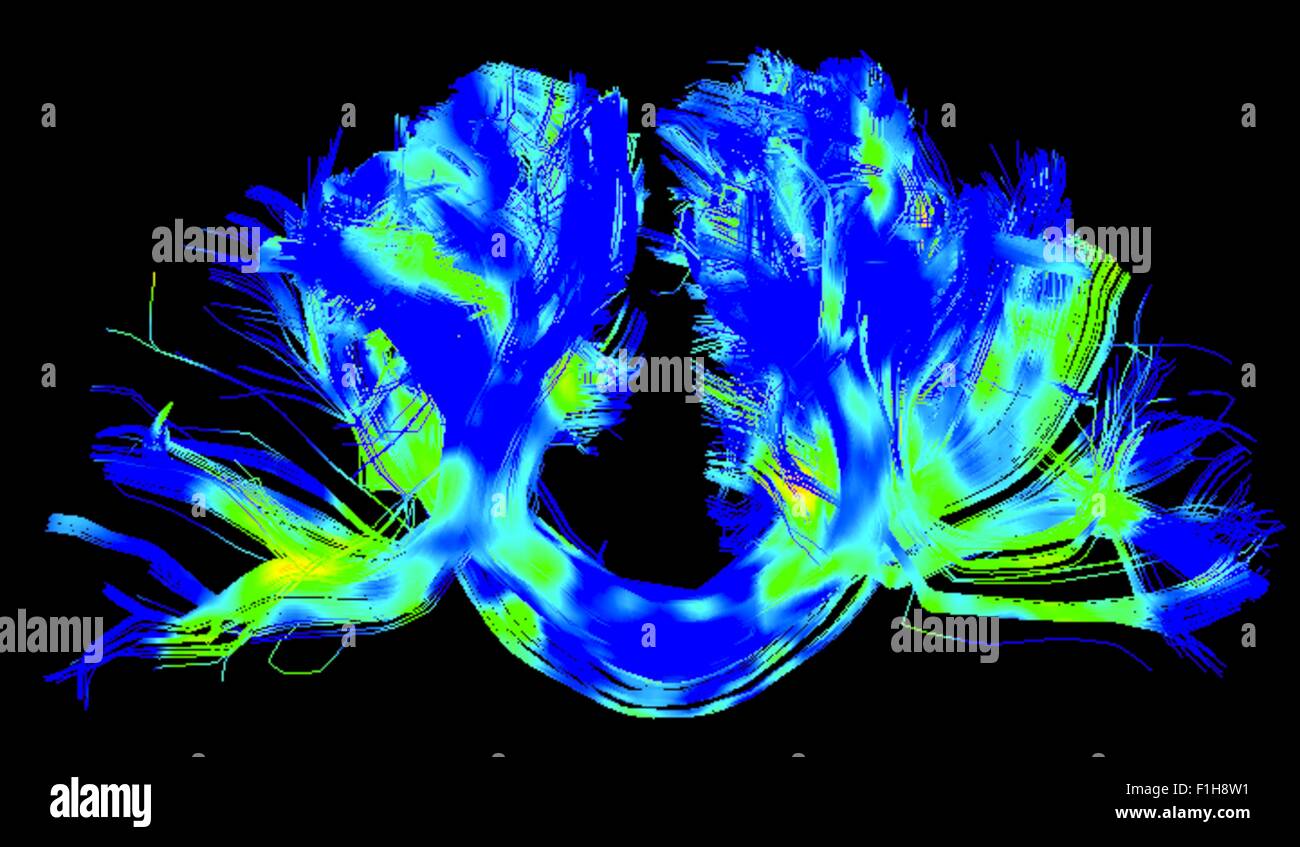 Corpus Callosum, rechts-links-Verbindungen in einer Parkinson Gehirn Stockfoto