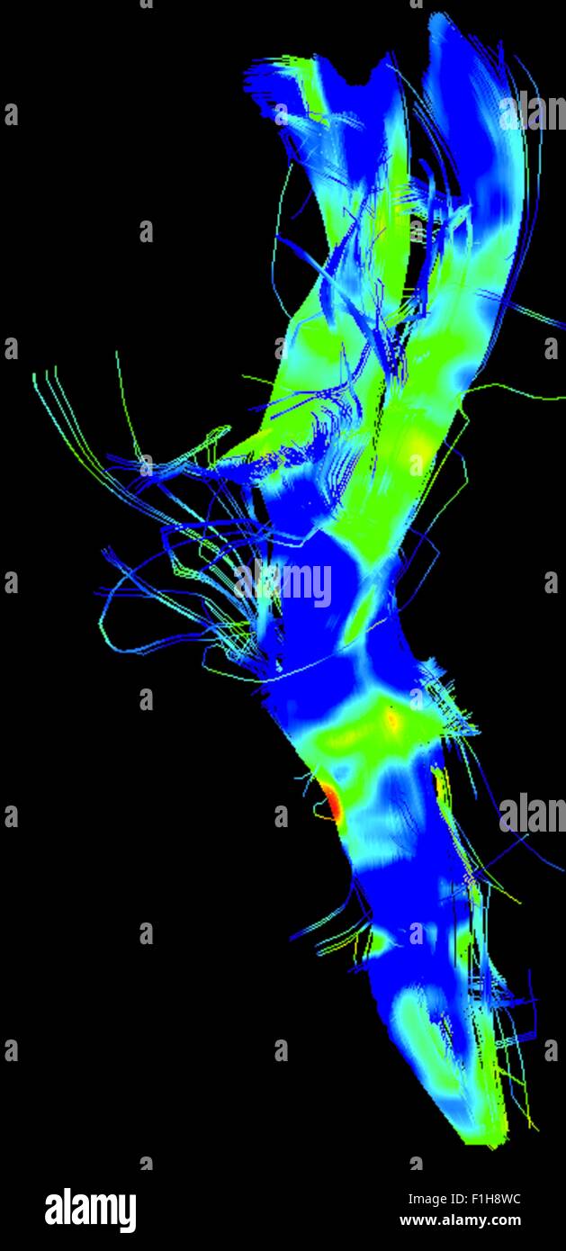 Kortikalen spinalen Trakt, große Bündel in das motorische System in einem Parkinson Gehirn Stockfoto