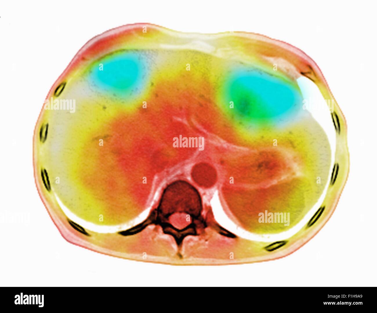 Co registrierte PET-CT Untersuchung dual Modalität Bildscanner. Patienten mehrere metastatischen Läsionen Leber & Lunge Stockfoto