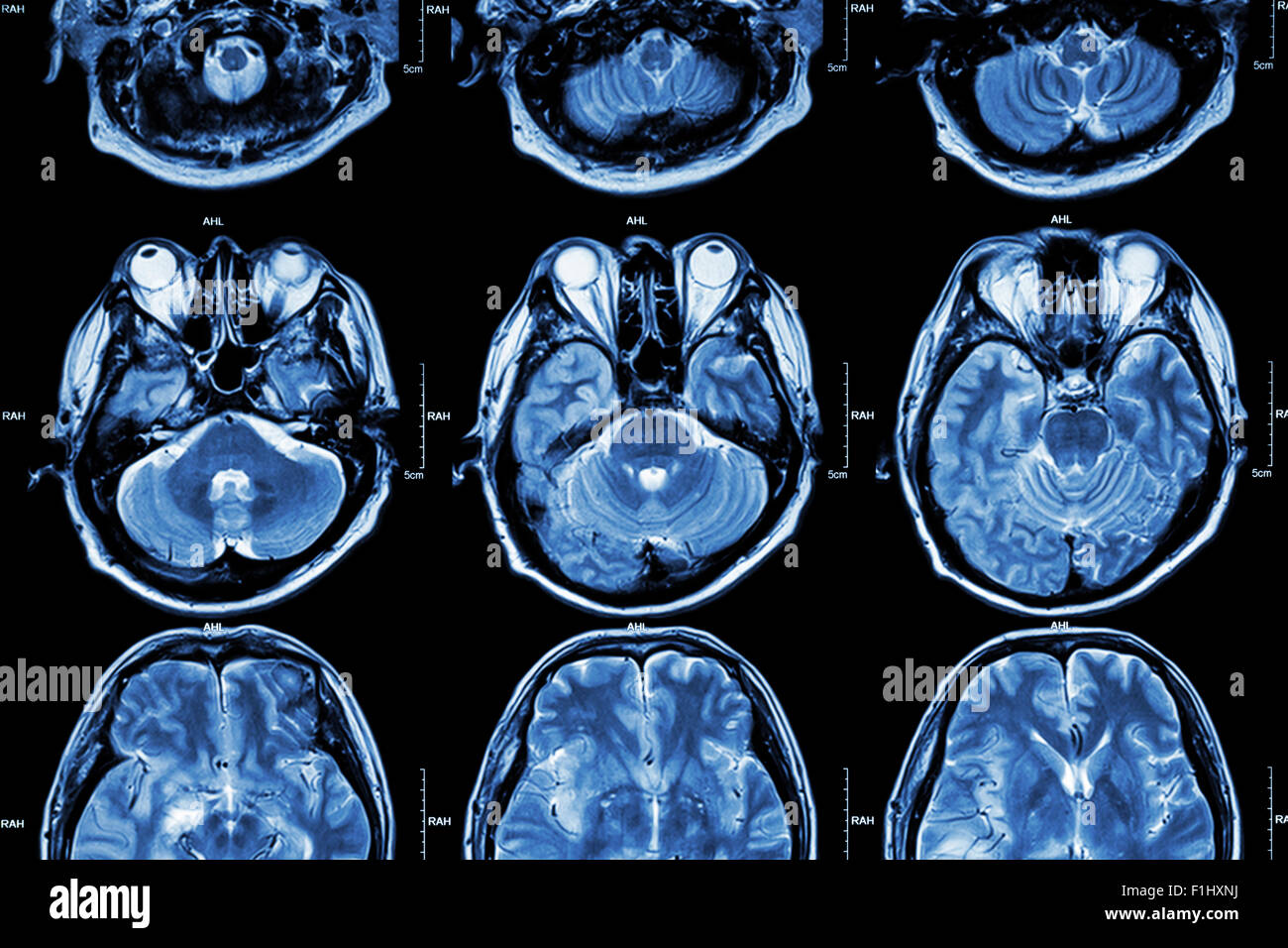 MRT des Gehirns (Querschnitt des Gehirns) (Medizin, Gesundheitswesen, Wissenschaft Hintergrund) Stockfoto