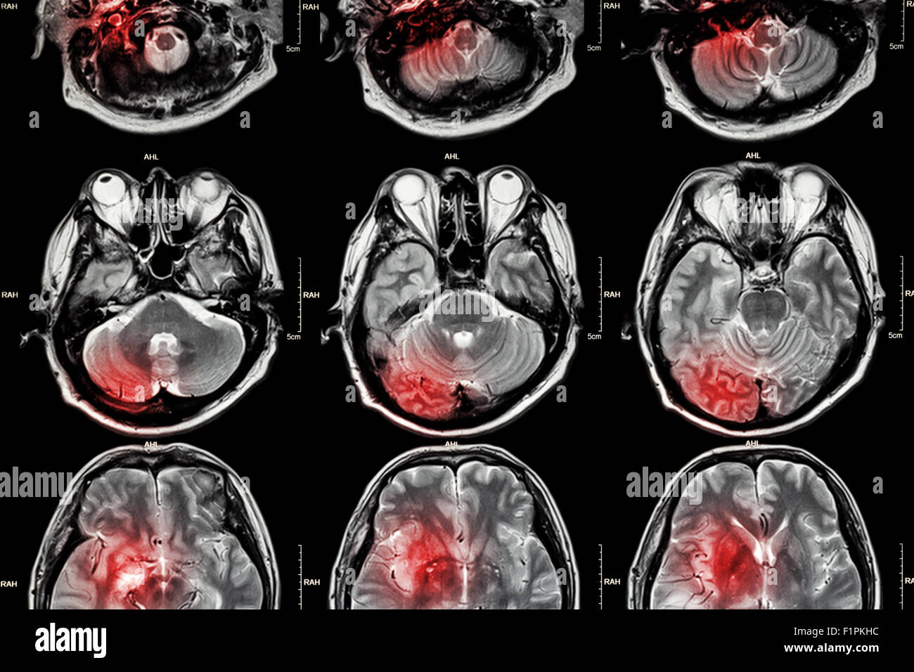 MRT (Magnet-Resonanz-Tomographie) des Gehirns zu Filmen (das MRT des Gehirns ist normale Gehirn aber roten Farbbereich ist künstlich für Qualitätssicherung Stockfoto