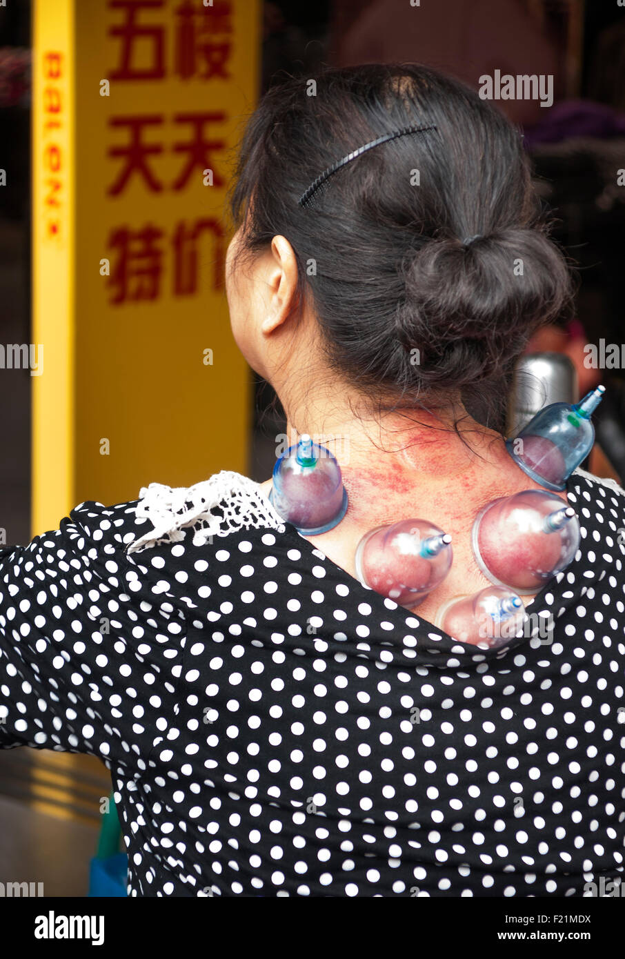 Frau erhält alten chinesischen Schröpfen-Technik, um ihre Schmerzen im Freien in einem beschäftigt shopping Area, Shanghai, China, Asien Stockfoto