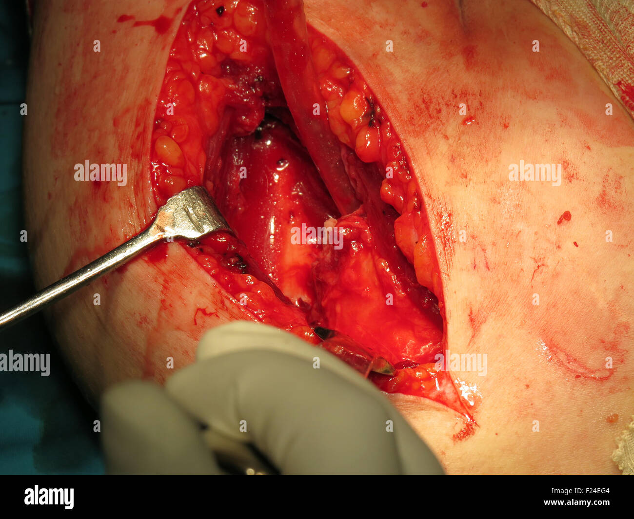 Eine Schulter mit einem gebrochenen Knochen für eine Operation vom Chirurgen geöffnet Stockfoto