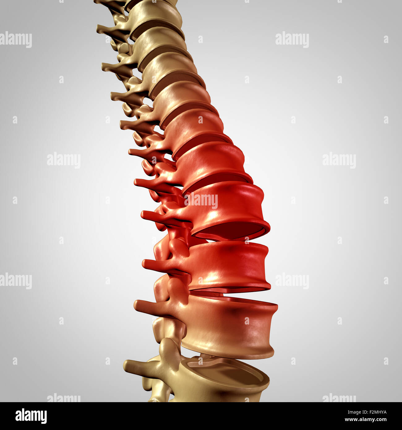Rückenschmerzen, unteren Rücken Krankheit und menschlichen Rückenschmerzen mit einem drei dimensionalen Wirbelsäule Körper Skelett zeigt die Wirbel und Wirbelsäule in leuchtenden Rot unterstreichen als ein medizinisches Gesundheits-Konzept für Gelenkschmerzen. Stockfoto