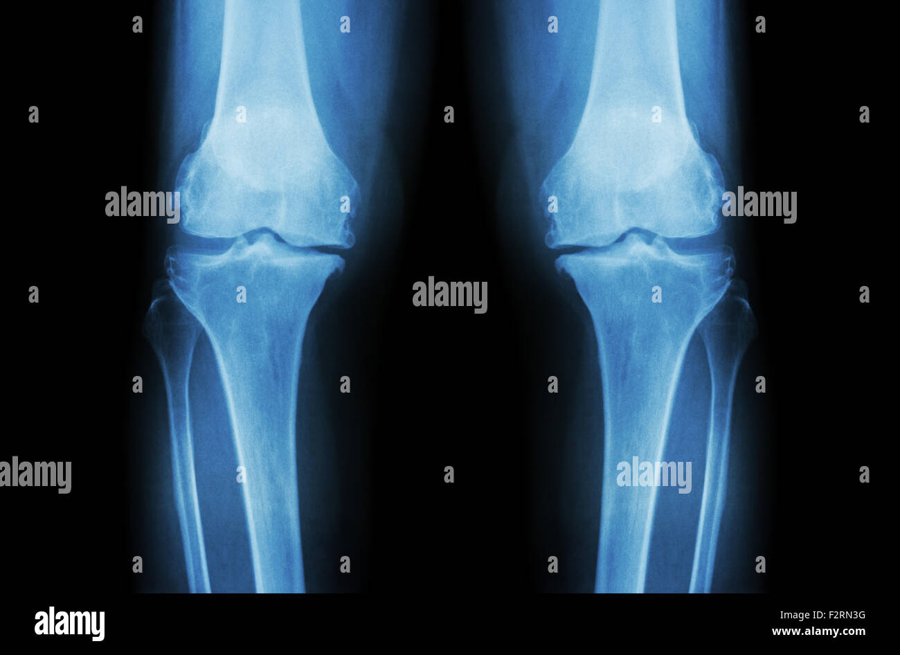 Knie Arthrose (OA Knie). Roentgenfilm beide Knie (Vorderansicht) zeigen enge gemeinsame Raum (Gelenkknorpel Verlust), Osteophy Stockfoto