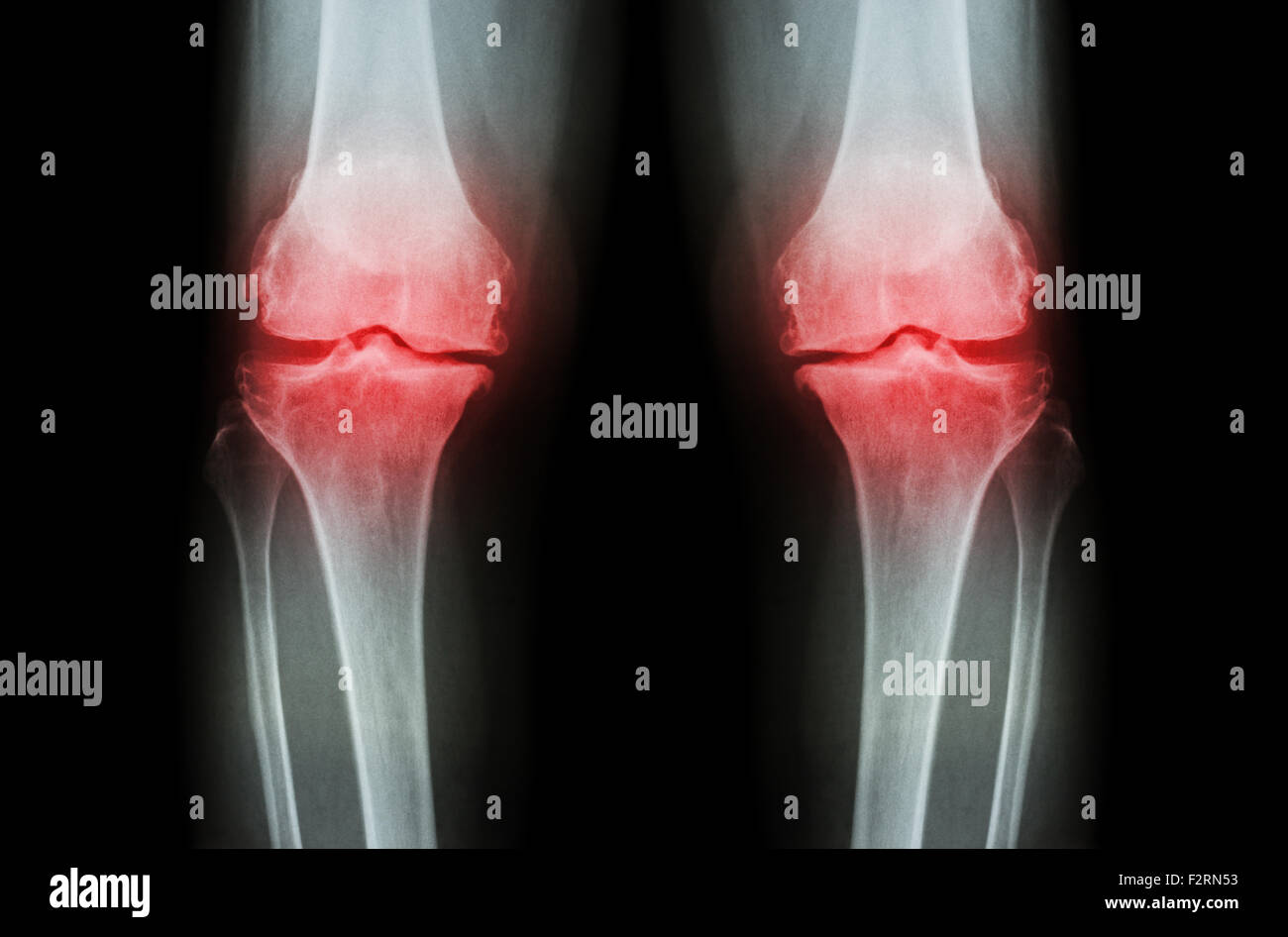 Knie Arthrose (OA Knie). Roentgenfilm beide Knie (Vorderansicht) zeigen enge gemeinsame Raum (Gelenkknorpel Verlust), Osteophy Stockfoto